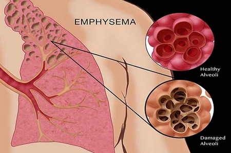 emphysema.jpg